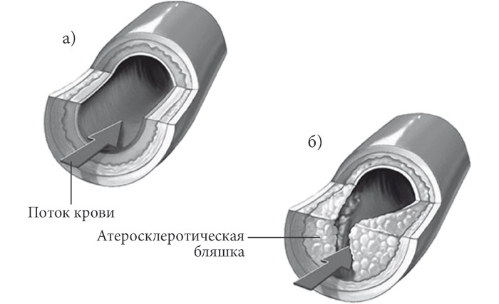 Лучшие методы лечения и профилактики инфаркта миокарда Лучшие методы лечения и профилактики инфаркта миокарда