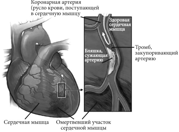 Лучшие методы лечения и профилактики инфаркта миокарда Лучшие методы лечения и профилактики инфаркта миокарда