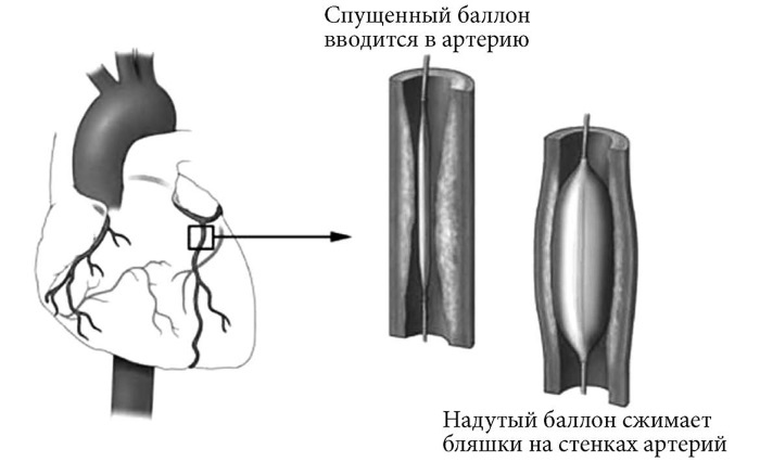 Лучшие методы лечения и профилактики инфаркта миокарда Лучшие методы лечения и профилактики инфаркта миокарда