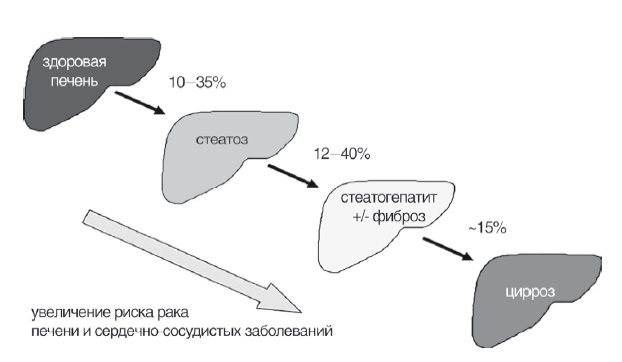 Неалкогольная жировая болезнь печени Неалкогольная жировая болезнь печени