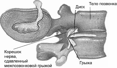 Заболевания позвоночника. Карманный справочник Заболевания позвоночника. Карманный справочник